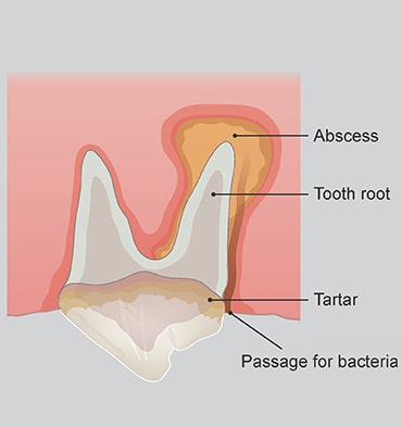 Illustration of tooth rot abscess