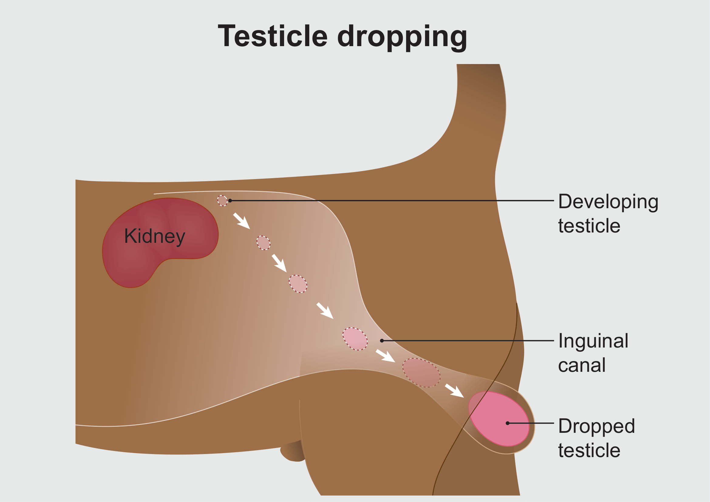 Look like testicle what does one disappearing of