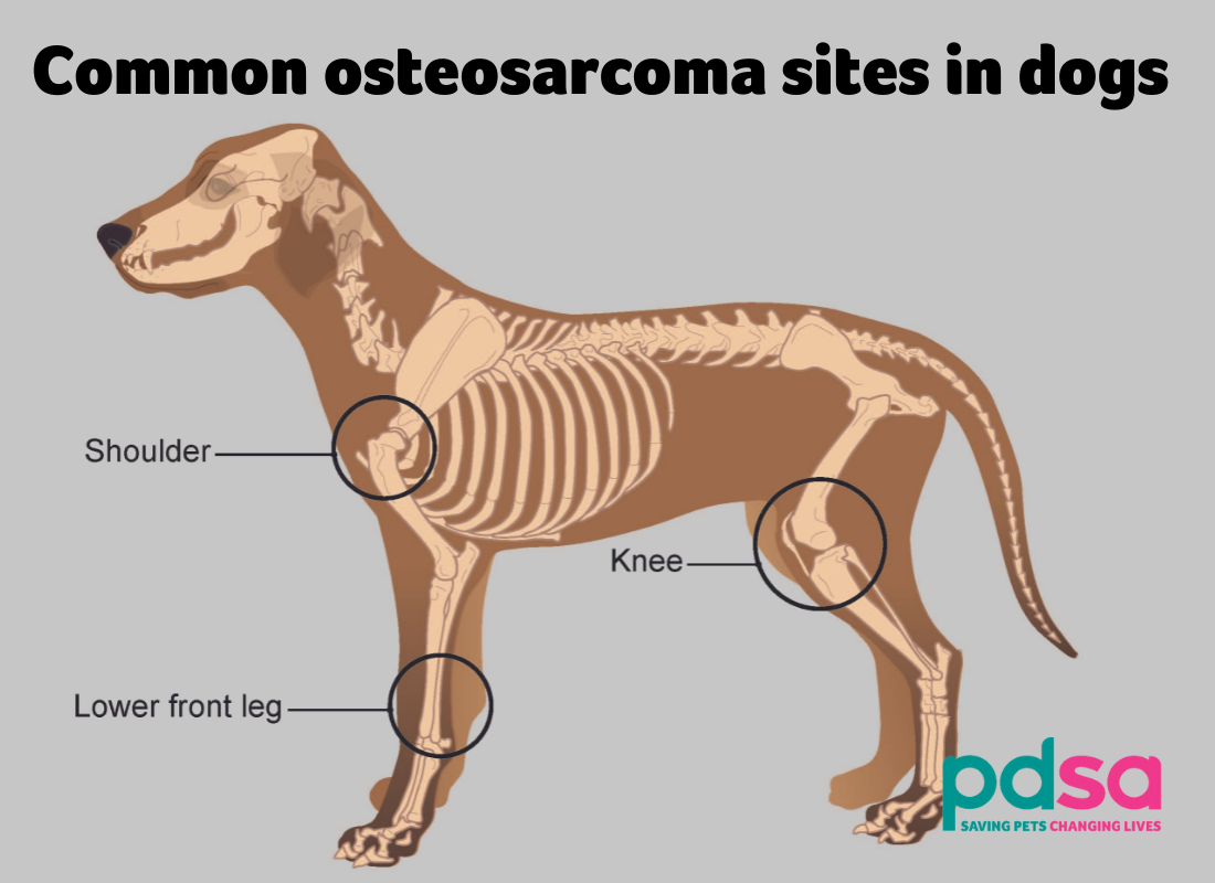 Illustration showing common places osteosarcomas develop
