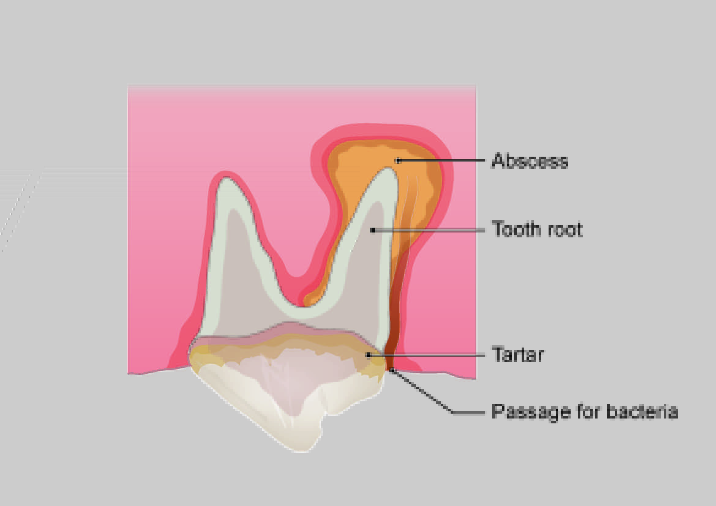 And illustration depicting a tooth rot abscess
