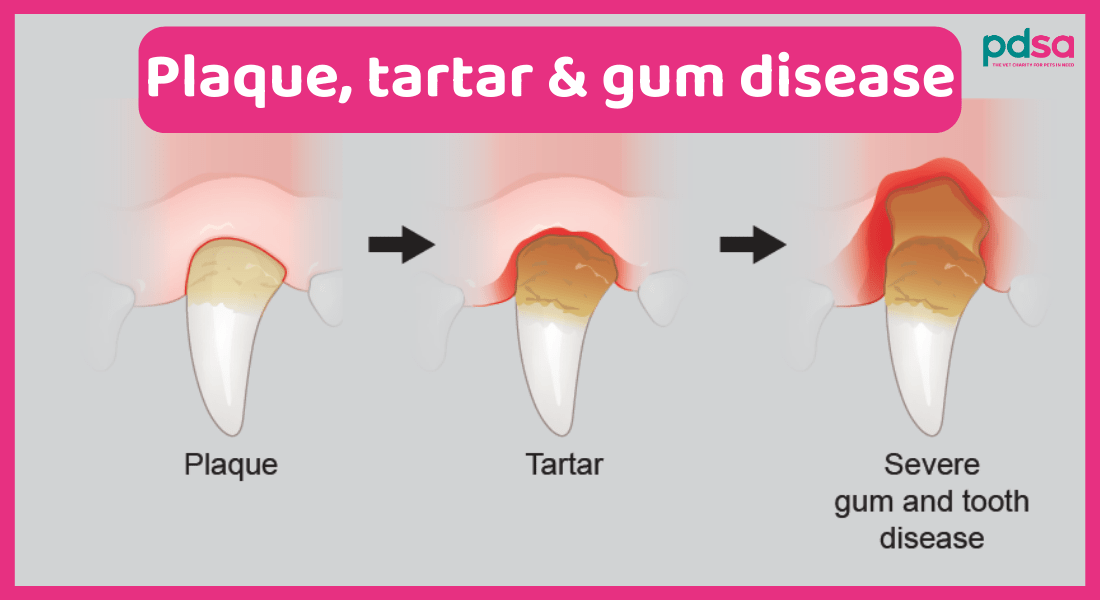 Illustration showing progression of gum disease