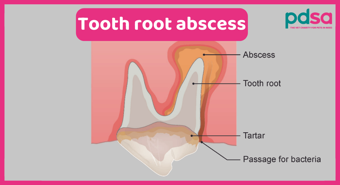 An illustration depicting a tooth rot abscess