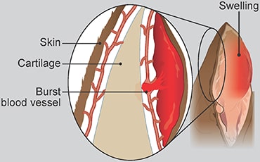 Illustration of an aural haematoma 