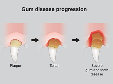 Illustration showing progression of gum disease