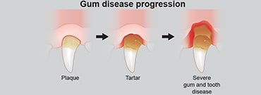 Illustration showing progression of gum disease