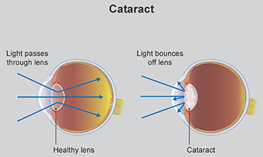 Illustration showing cataracts in a dog's eye