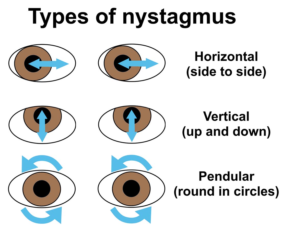 Nystagmus (flickering eye movements) in a dog PDSA