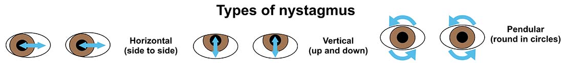 Illustration showing types of nystagmus