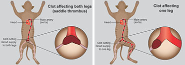 Illustration showing saddle thrombus