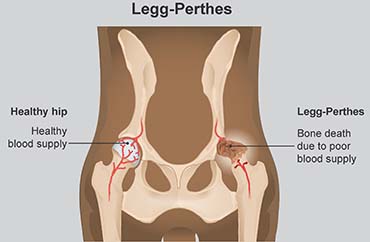 Illustration showing Legge-Perthes vs healthy hip