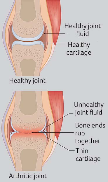 Illustration showing a healthy joint against an arthritic one