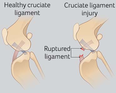 Illustration showing cruciate damage. 